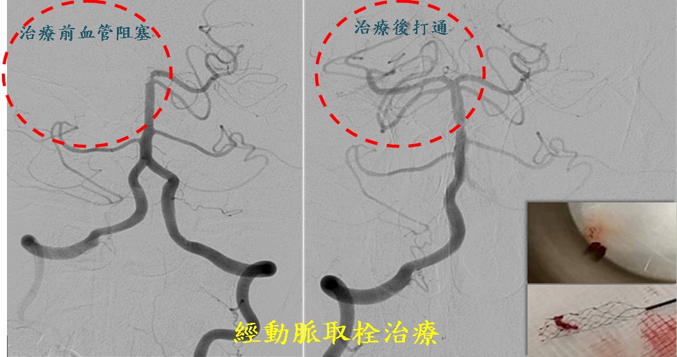 經動脈取栓治療