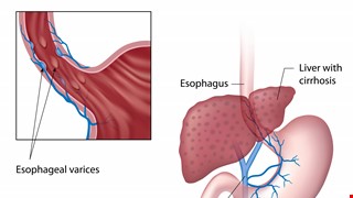 Esophageal Varices and Bleeding 食道靜脈曲張及出血