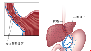 食道靜脈曲張及出血