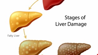 Liver Cirrohsis 肝硬化診斷與治療