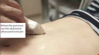 Paracentesis for Ascites 做腹腔穿刺術，我該注意什麼？