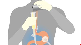 Home Care After Endoscopic Gastrostomy 內視鏡胃造口術後之居家護理
