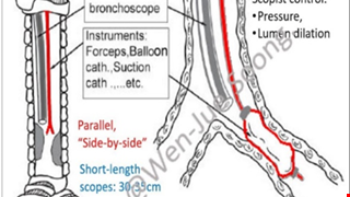 Pediatric Tracheobronchial Stent Post-Operative Instructions 兒童氣管支架術後說明