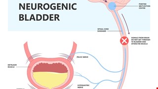 Neurogenic Bladder 神經性膀胱