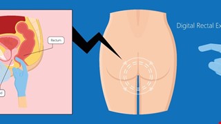 攝護腺癌篩檢 肛門指診