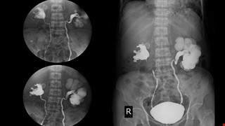 逆行性腎盂攝影術檢查說明