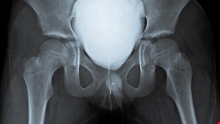 Urethral Stricture 尿道狹窄