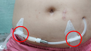 Peritoneal Dialysis Catheter Care 腹膜透析導管照護原則