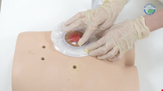 Ostomy supplies device method 腸造口用品裝置方法