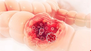 Colorectal Cancer 了解大腸直腸癌