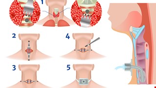 Tracheotomy 氣管切開術