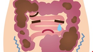 Meckel Diverticulum Scan 核醫梅克爾憩室症檢查