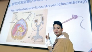 腹腔高壓氣霧化療對抗難處理的「腹膜惡性腫瘤」用噴的化療更精準！