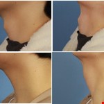 喉結手術、無疤痕喉結減積手術 （Scarless Thyroid Cartilage Reduction）