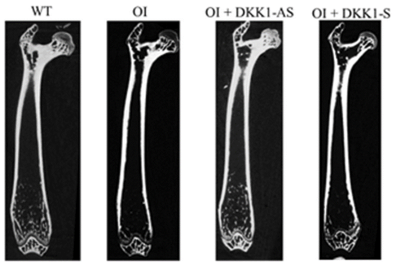 Dickkopf-1 (DKK1) blockade mitigates osteogenesis imperfecta (OI) related bone disease