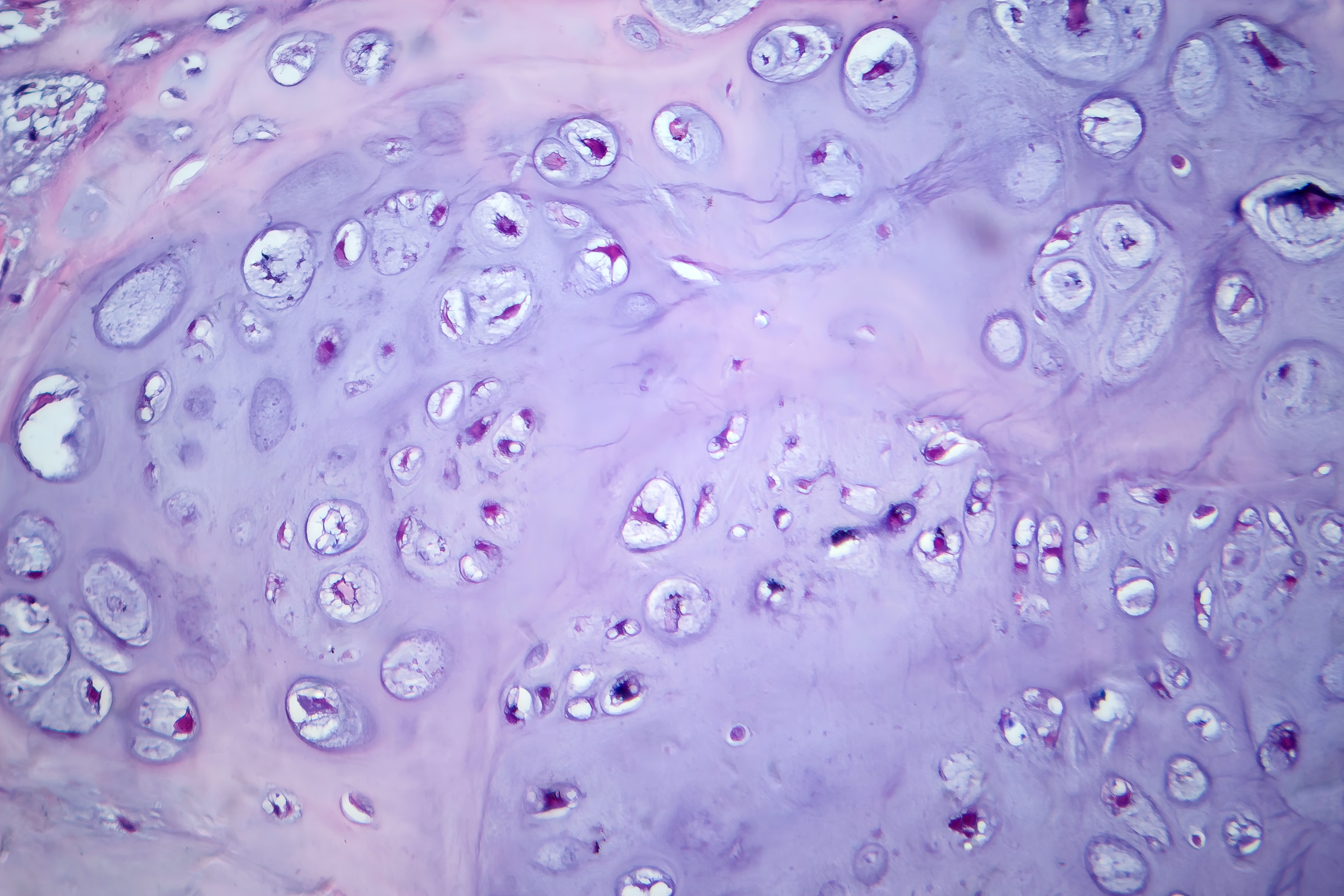 NAMPT enhances LOX expression and promotes metastasis in human chondrosarcoma cells by inhibiting miR-26b-5p synthesis img