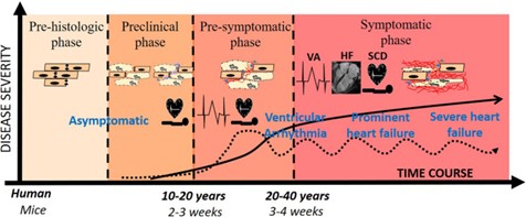 Pathogenesis of Arrhythmogenic Cardiomyopathy: Role of Inflammation